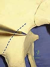 صورة أشعة مقطعية ثلاثية الأبعاد للتخطيط الجراحي