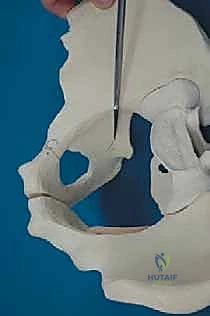 صورة طبية: قطع عظم حول الحُق البيرني: حل متقدم للحفاظ على مفصل الورك في صنعاء مع الأستاذ الدكتور محمد هطيف