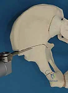 رسم يوضح الفرق بين الورك الطبيعي والمصاب بخلل التنسج