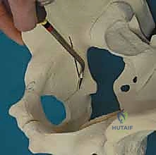 صورة طبية: قطع عظم حول الحُق البيرني: حل متقدم للحفاظ على مفصل الورك في صنعاء مع الأستاذ الدكتور محمد هطيف