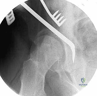 صورة طبية: قطع عظم حول الحُق البيرني: حل متقدم للحفاظ على مفصل الورك في صنعاء مع الأستاذ الدكتور محمد هطيف