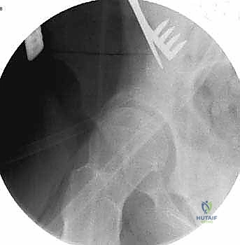 تخطيط ما قبل الجراحة باستخدام البرامج المتقدمة
