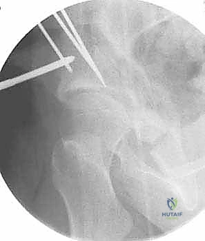 صورة توضيحية لـ قطع عظم حول الحُق البيرني: حل متقدم للحفاظ على مفصل الورك في صنعاء مع الأستاذ الدكتور محمد هطيف