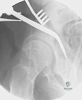 تقييم زاوية مفصل الورك قبل الجراحة