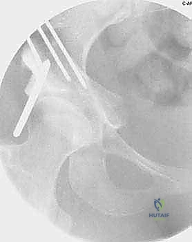 صورة توضيحية لـ قطع عظم حول الحُق البيرني: حل متقدم للحفاظ على مفصل الورك في صنعاء مع الأستاذ الدكتور محمد هطيف