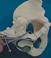 صورة طبية: قطع عظم حول الحُق البيرني: حل متقدم للحفاظ على مفصل الورك في صنعاء مع الأستاذ الدكتور محمد هطيف