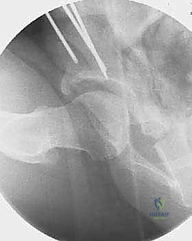 صورة طبية: قطع عظم حول الحُق البيرني: حل متقدم للحفاظ على مفصل الورك في صنعاء مع الأستاذ الدكتور محمد هطيف