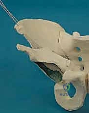 صورة توضيحية لـ قطع عظم حول الحُق البيرني: حل متقدم للحفاظ على مفصل الورك في صنعاء مع الأستاذ الدكتور محمد هطيف