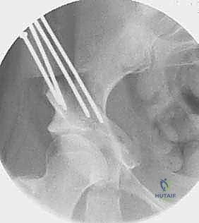 صورة طبية: قطع عظم حول الحُق البيرني: حل متقدم للحفاظ على مفصل الورك في صنعاء مع الأستاذ الدكتور محمد هطيف