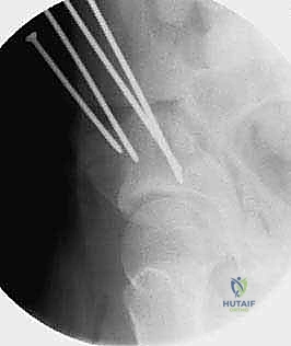 صورة طبية: قطع عظم حول الحُق البيرني: حل متقدم للحفاظ على مفصل الورك في صنعاء مع الأستاذ الدكتور محمد هطيف