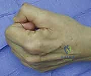 التشخيص والتقييم السريري الدقيق لشلل العصب الزندي