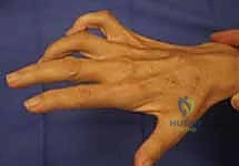 استعادة وظيفة اليد بعد شلل العصب الزندي: دليل شامل لنقل الأوتار مع الأستاذ الدكتور محمد هطيف في صنعاء