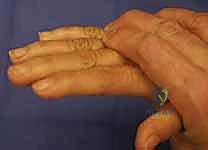 التخطيط الجراحي والمبادئ الميكانيكية الحيوية لنقل الأوتار