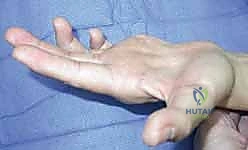 التشوه المخلبي لليد الناتج عن شلل العصب الزندي