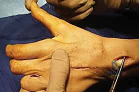 صورة توضيحية لـ استعادة وظيفة اليد بعد شلل العصب الزندي: دليل شامل لنقل الأوتار مع الأستاذ الدكتور محمد هطيف في صنعاء