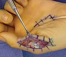 صورة توضيحية لـ استعادة وظيفة اليد بعد شلل العصب الزندي: دليل شامل لنقل الأوتار مع الأستاذ الدكتور محمد هطيف في صنعاء