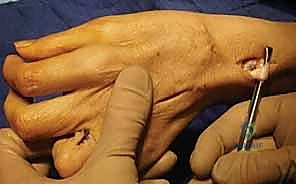 صورة توضيحية لـ استعادة وظيفة اليد بعد شلل العصب الزندي: دليل شامل لنقل الأوتار مع الأستاذ الدكتور محمد هطيف في صنعاء