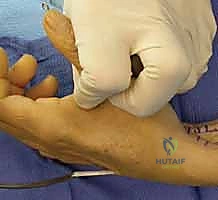 أسباب انضغاط وإصابة العصب الزندي وتأثيرها على اليد