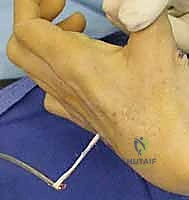 صورة توضيحية لـ استعادة وظيفة اليد بعد شلل العصب الزندي: دليل شامل لنقل الأوتار مع الأستاذ الدكتور محمد هطيف في صنعاء