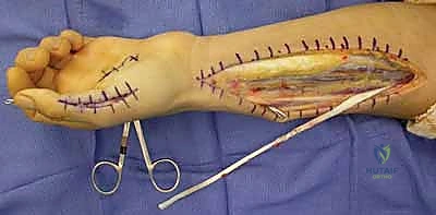 التشريح المعقد للعصب الزندي في الساعد واليد