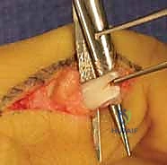 صورة توضيحية لـ استعادة وظيفة اليد بعد شلل العصب الزندي: دليل شامل لنقل الأوتار مع الأستاذ الدكتور محمد هطيف في صنعاء