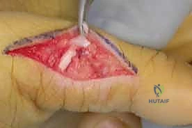 صورة توضيحية لـ استعادة وظيفة اليد بعد شلل العصب الزندي: دليل شامل لنقل الأوتار مع الأستاذ الدكتور محمد هطيف في صنعاء