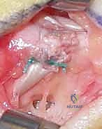 صورة توضيحية لـ استعادة وظيفة اليد بعد شلل العصب الزندي: دليل شامل لنقل الأوتار مع الأستاذ الدكتور محمد هطيف في صنعاء