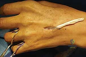 استعادة وظيفة اليد بعد شلل العصب الزندي: دليل شامل لنقل الأوتار مع الأستاذ الدكتور محمد هطيف في صنعاء