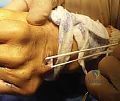 Illustration of third web space - Dr. Mohammed Hutaif