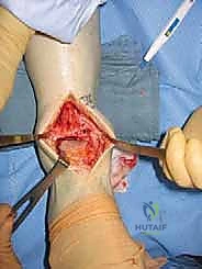 استبدال مفصل الكاحل الكلي Agility: حل دائم لآلام الكاحل المزمنة في صنعاء مع الأستاذ الدكتور محمد هطيف