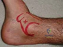 الدكتور محمد هطيف رائد جراحة العظام في اليمن