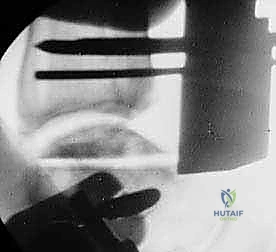 صورة طبية: استبدال مفصل الكاحل الكلي Agility: حل دائم لآلام الكاحل المزمنة في صنعاء مع الأستاذ الدكتور محمد هطيف