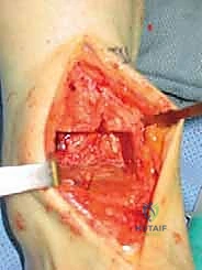 صورة توضيحية لـ استبدال مفصل الكاحل الكلي Agility: حل دائم لآلام الكاحل المزمنة في صنعاء مع الأستاذ الدكتور محمد هطيف