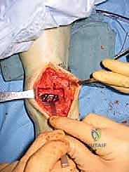 صورة توضيحية لـ استبدال مفصل الكاحل الكلي Agility: حل دائم لآلام الكاحل المزمنة في صنعاء مع الأستاذ الدكتور محمد هطيف