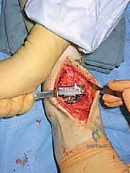 صورة توضيحية لـ استبدال مفصل الكاحل الكلي Agility: حل دائم لآلام الكاحل المزمنة في صنعاء مع الأستاذ الدكتور محمد هطيف