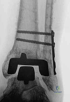 صورة توضيحية لـ استبدال مفصل الكاحل الكلي Agility: حل دائم لآلام الكاحل المزمنة في صنعاء مع الأستاذ الدكتور محمد هطيف