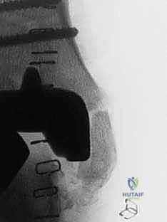 صورة طبية: مراجعة مفصل الكاحل الصناعي (Agility) وعلاج كسور الكعب: دليل شامل للمرضى