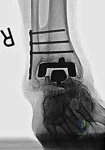 صورة طبية: مراجعة مفصل الكاحل الصناعي (Agility) وعلاج كسور الكعب: دليل شامل للمرضى