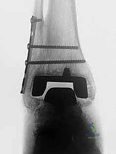 صورة طبية: مراجعة مفصل الكاحل الصناعي (Agility) وعلاج كسور الكعب: دليل شامل للمرضى