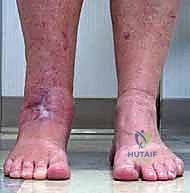 صورة طبية: مراجعة مفصل الكاحل الصناعي (Agility) وعلاج كسور الكعب: دليل شامل للمرضى