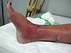 صورة طبية: مراجعة مفصل الكاحل الصناعي (Agility) وعلاج كسور الكعب: دليل شامل للمرضى