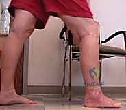 صورة طبية: مراجعة مفصل الكاحل الصناعي (Agility) وعلاج كسور الكعب: دليل شامل للمرضى