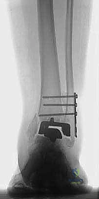 مراجعة مفصل الكاحل الصناعي (Agility) وعلاج كسور الكعب: دليل شامل للمرضى