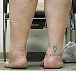 صورة طبية: مراجعة مفصل الكاحل الصناعي (Agility) وعلاج كسور الكعب: دليل شامل للمرضى