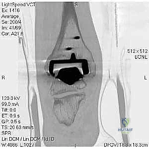 صورة شعاعية توضح حالة المفصل