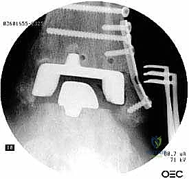 فشل ميكانيكي للمفصل القديم