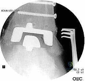 تآكل عظمي حول الزرعة