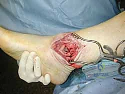 صورة طبية: مراجعة مفصل الكاحل الصناعي (Agility) وعلاج كسور الكعب: دليل شامل للمرضى