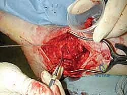 تجهيز الطعم العظمي