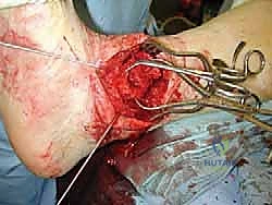 صورة طبية: مراجعة مفصل الكاحل الصناعي (Agility) وعلاج كسور الكعب: دليل شامل للمرضى